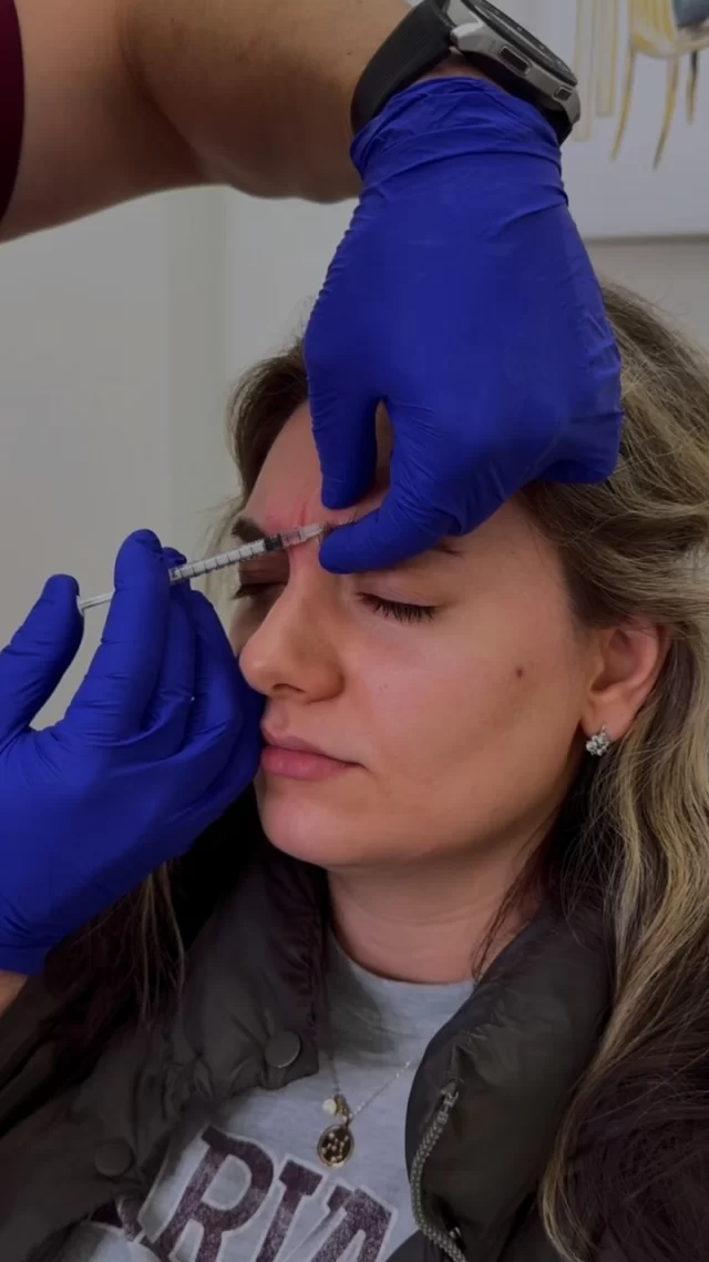 PRP Microneedling Staten Island